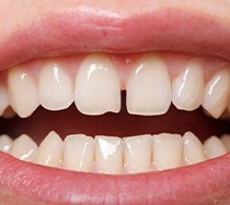 gapped teeth that require Invisalign in New Bedford