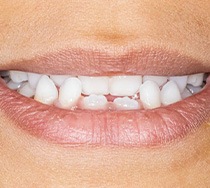 an example of underbite that needs Invisalign in New Bedford